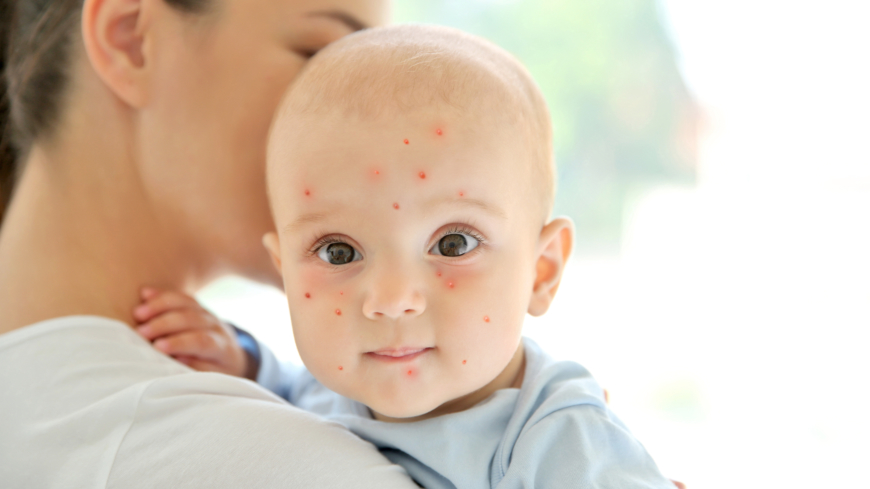 Vaccin mot mässling ingår i grundvaccinet i Sverige.  Foto: Shutterstock